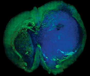 Imagen: Imagen de microscopia de dispersión Raman estimulada (SRS, por su sigla en inglés) de un tumor cerebral, glioblastoma humano (azul), rodeado por tejido normal (verde) (Fotografía cortesía de la Universidad de Harvard).